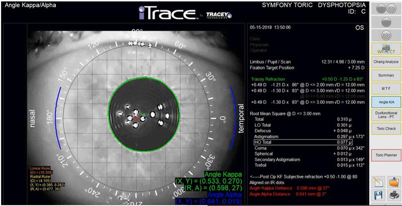 iTRACE Eye Scan