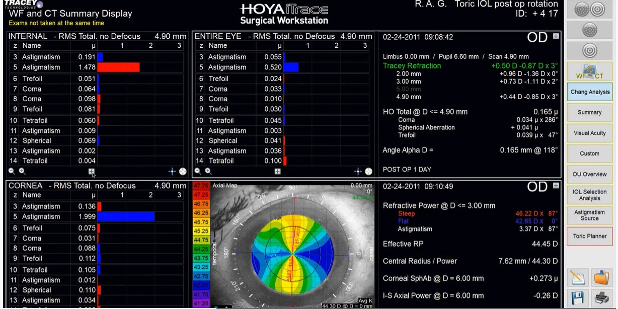 The iTrace version 5 Advanced Eye Clinic