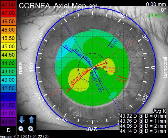 iTrace Cornea Axial Map Display