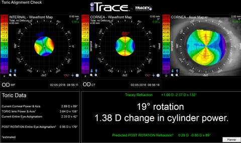 iTrace Dysfunctional Lens Index