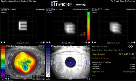 iTrace Dysfunctional Lens Index