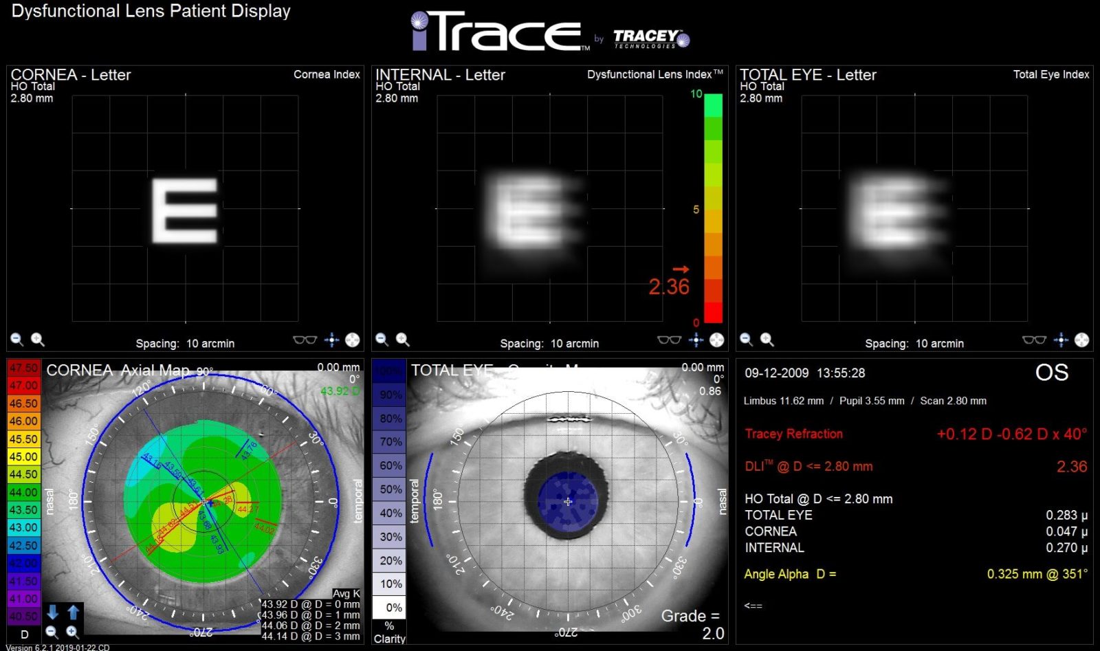 iTrace 功能失調的晶狀體患者顯示幕