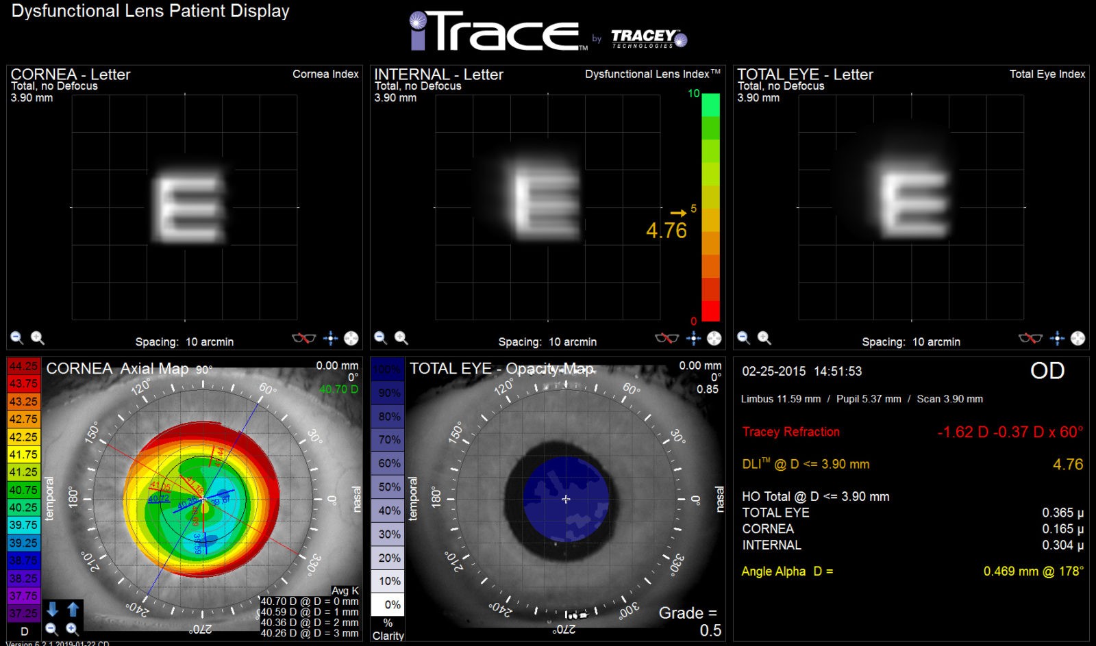 itrace eye scan dysfunctional lens patient display