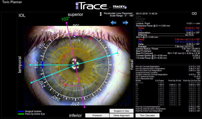 itrace eye scan toric planner