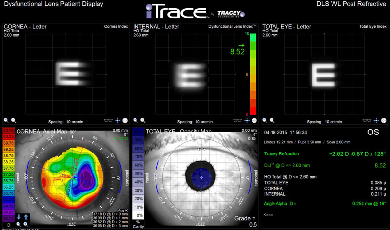 iTrace Dysfunctional Lens Index