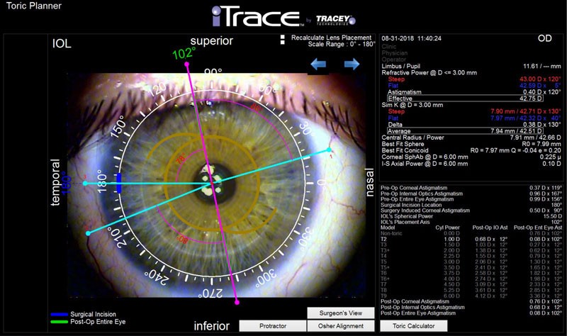 Toric IOL Planning