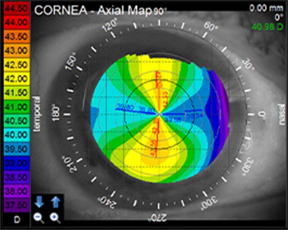 The toric check cornea axial map