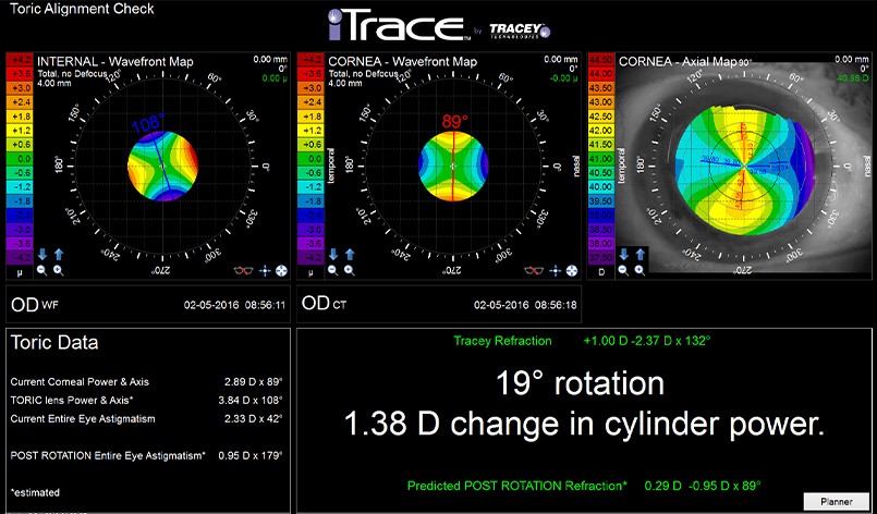 The iTrace toric aligment check from Tracey Technologies
