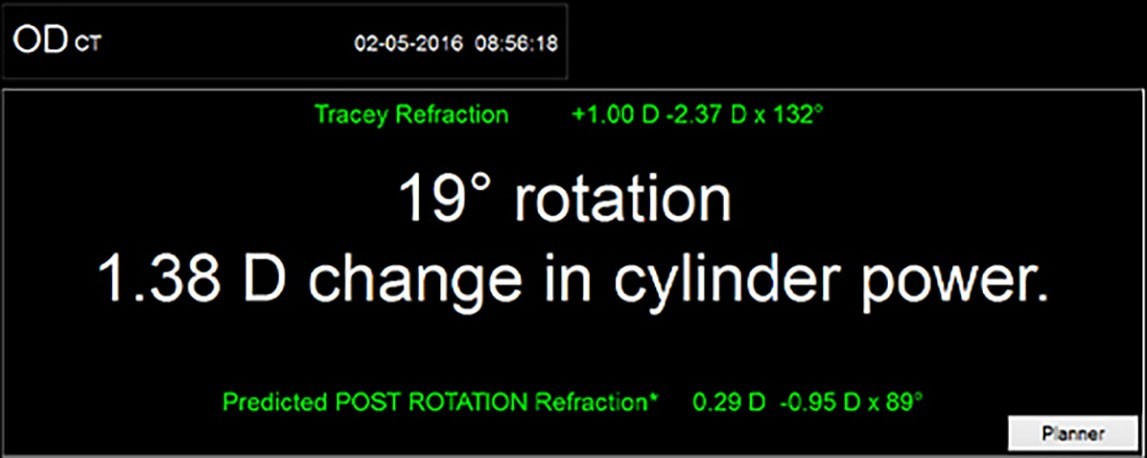 Toric check Tracey refraction display