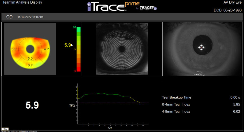 The Proprietary Tear Film Index at Tracey Technologies