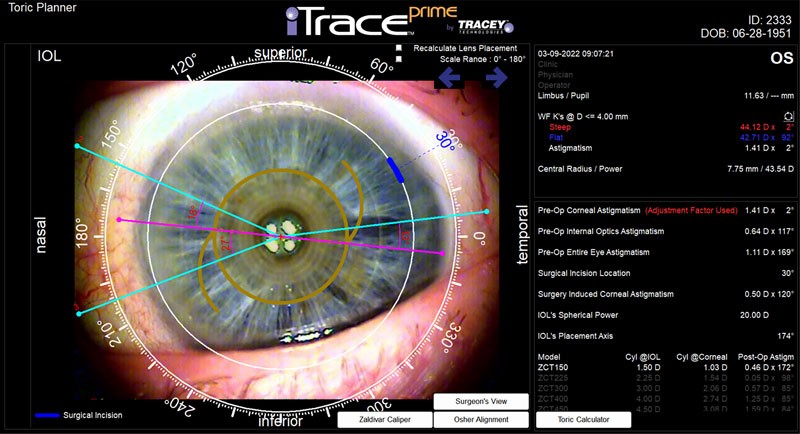 Toric Planner iTrace