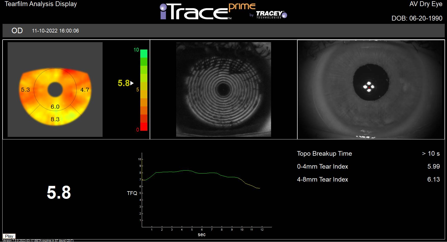 iTrace Dysfunctional Lens Patient Display